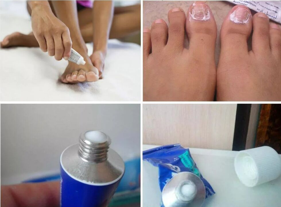 medicament pentru ciuperca unghiilor de la picioare